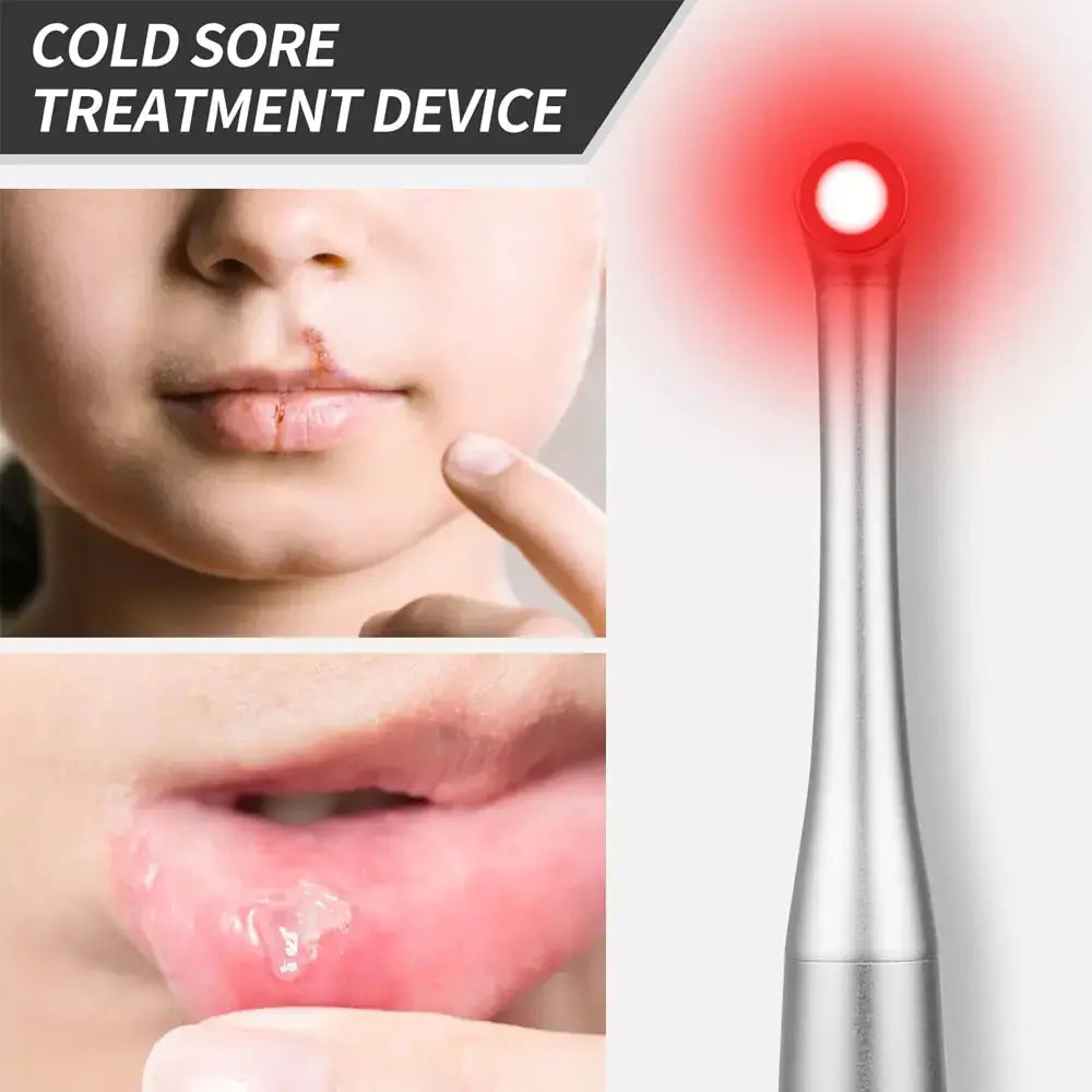 Allebuy cold sore treatment device with red-light therapy for effective lip healing